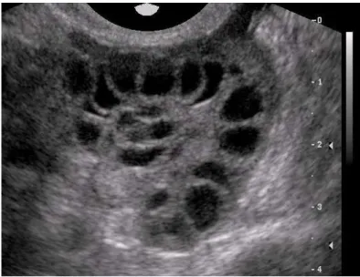 Şekil 1: Polikistik over ultrasound görüntüsü 