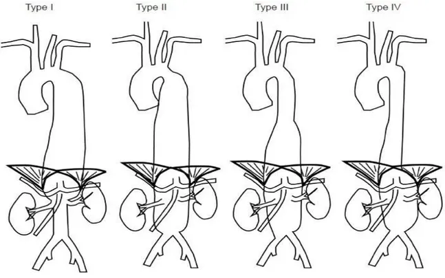 Şekil 4: Torakoabdominal aort anevrizmalarında Crawford Sınıflaması 