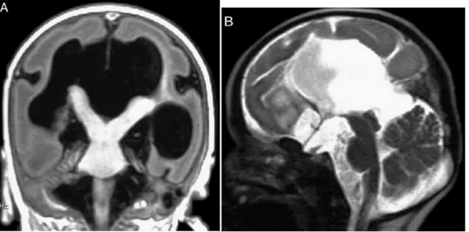Şekil 6. X’e bağlı geçen lizensefalili erkek hastaya ait beyin MRI; koronal kesit (A) ve sagittal  kesit  (B)