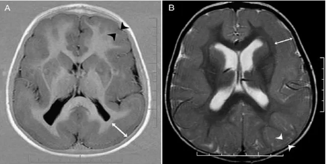 Şekil 7. LIS1 gen mutasyonlu klasik lizensefali hastası (erkek) (A): Beyin MRI: aksiyal kesit:;  (B)  DCX  mutasyonlu  bayanda  lizensefali