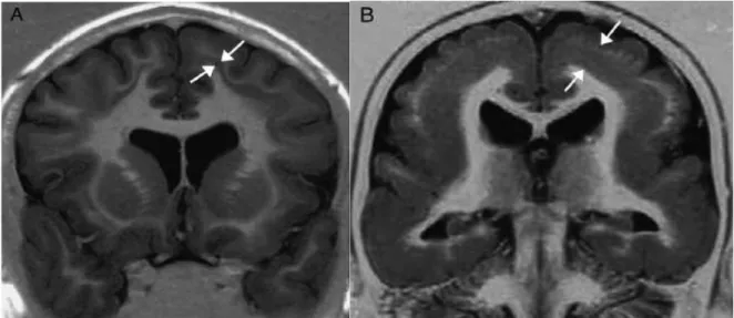 Şekil 9. DCX gen mutasyonunun etkilediği hastalarda beyin MRG. (A,B) Beyin MRG: DCX  geninin farklı iki mutasyonunu taşıyan iki genç kadının coronal kesitleri