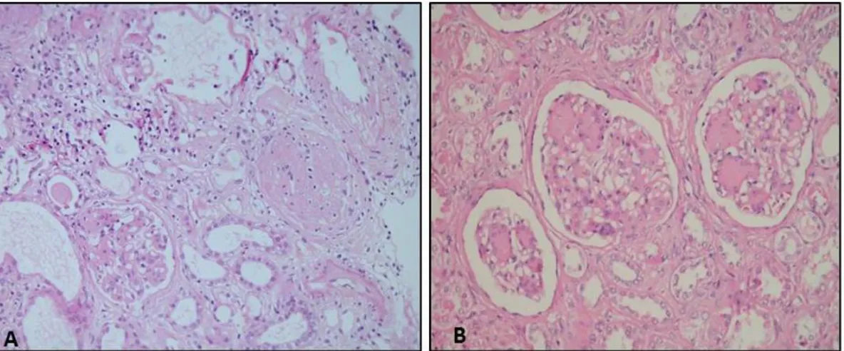 Şekil 10. A:  Segmental ve global skleroz gösteren glomerüller  B: Nodüler skleroz 
