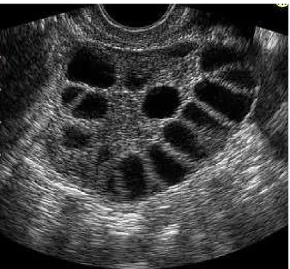 Şekil 1. Polikistik over ultrasound görüntüsü 