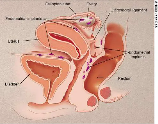 Şekil 2- Endometriozisin peritoneal lezyonları 