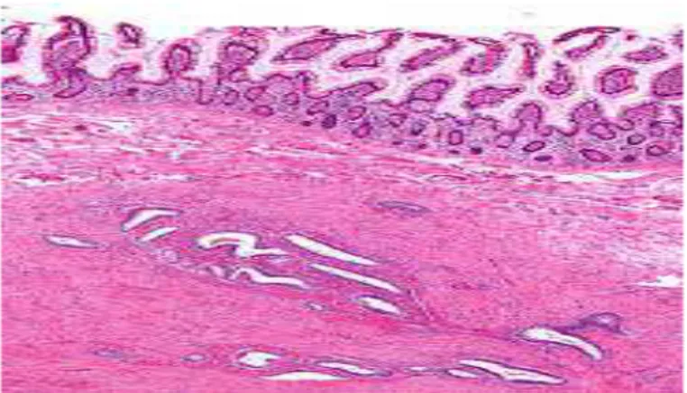 Şekil 6-  Endometriozisin mikroskopik görünümü 