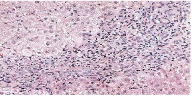 Şekil 4: İnterface hepatit 