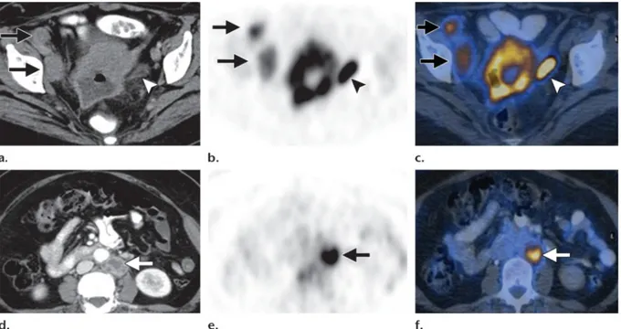 Şekil  4:  servikal  tümörlü  olguda  siyah  okla  gösterilen  sağ  illiak  lenf  nodu  metastazı,  beyaz  okla  gösterilen  FDG  tutulumu  ise  üreter  dilastonudur