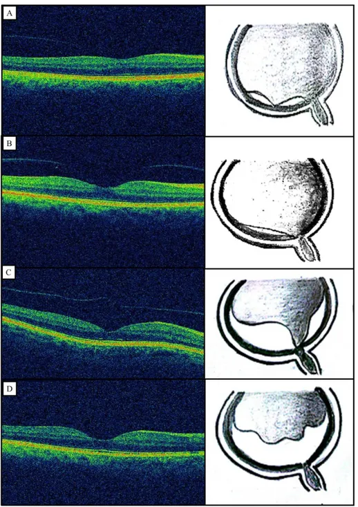 Şekil 5 Optik koherens tomografiye göre PVD' nin evrelenmesi. A) Evre 1 PVD’ nin  sadece fovea çevresine lokalize olduğu ve foveada, optik sinir başında ve midperifer  retinada vitreus yapışıklığının devam ettiği inkomplet PVD olarak tanımlanmıştır