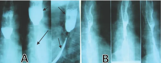 Şekil 7. A:Baryumlu görüntülerde orta ve distal özofagusta daralma ,proximalde dilatasyon B: 