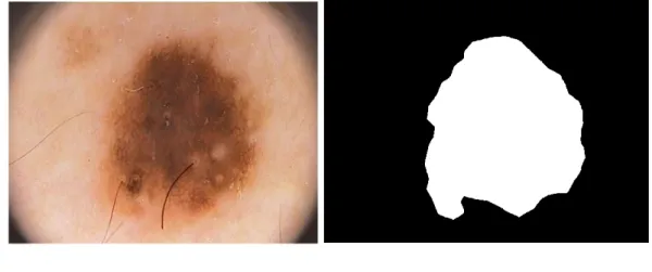 Şekil 2.1. Melanom kanseri görüntüsü PH2 veri kümesi görüntülerinden IMD002, a) Orijinal  RGB   görüntüsü,  b)gerçek  referans  değeri  olarak   bilinen   melanomun  manuel   Bölütlemesi