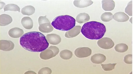 Şekil 1.1. ALL olan bir hastanın kan yayılması (lösemi hücreleri) 