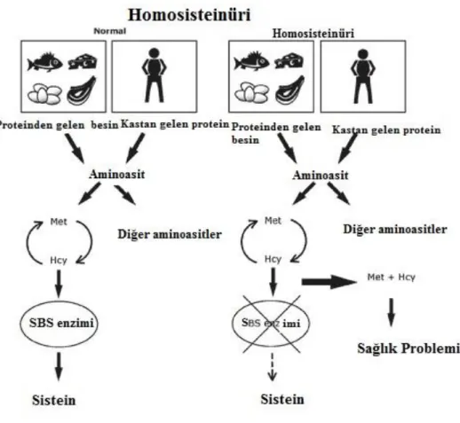 Şekil 7. Homosisteinüri 