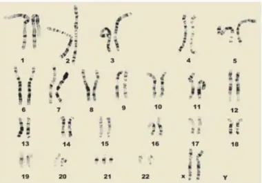 Şekil 2.1. DS’li olan bireyin kromozom yapısı 