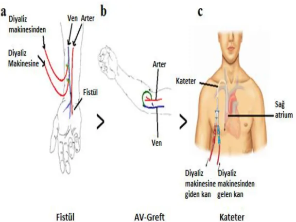 Şekil  1.2.  Damar  yolu  çeşitleri:  a)  Arteriovenöz  fistül  b)  Arteriovenöz  greft  ve  c)  Santral  venöz kateter (Al -Jaishi, 2013).