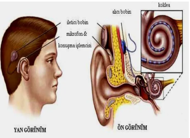 Şekil  8.  Koklear  implant.  http://www.sessizligimesesver.com/koklear-implantlar