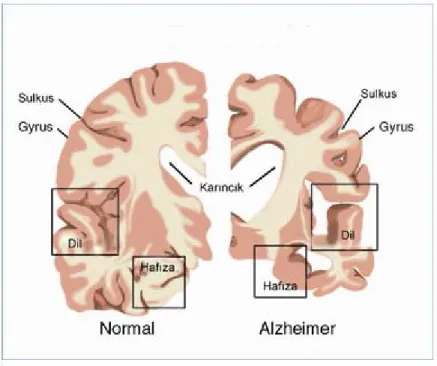 Şekil 3.2 Alzheimer tarafından etkilenen beyin bölgeleri ve ventriküllerin boyutlarındaki  değişiklikler ve sağlıklı beyin dokusu kaybı 