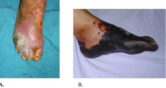 Şekil 6. A, B. Ayakta amputasyon gerektiren enfeksiyon ve dolaşım.