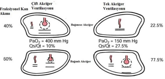 Şekil 2. Transpulmoner şant (48).