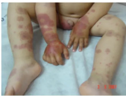 Figure 1: The  asymmetric purpuric lesions  and  edema  which  located  dominantly  on  the  right side of the body are seen