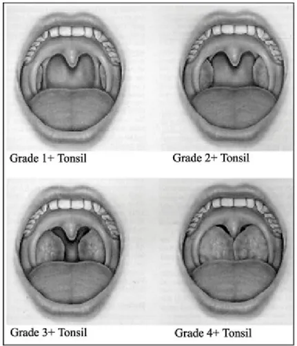 Şekil 2. Tonsillerin Brodsky skalasına göre evrelemesi