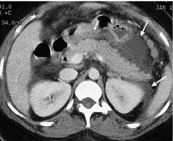 Şekil 13: AP’de axial CT’de pankreas ve retroperitoneal dokuda ödem.