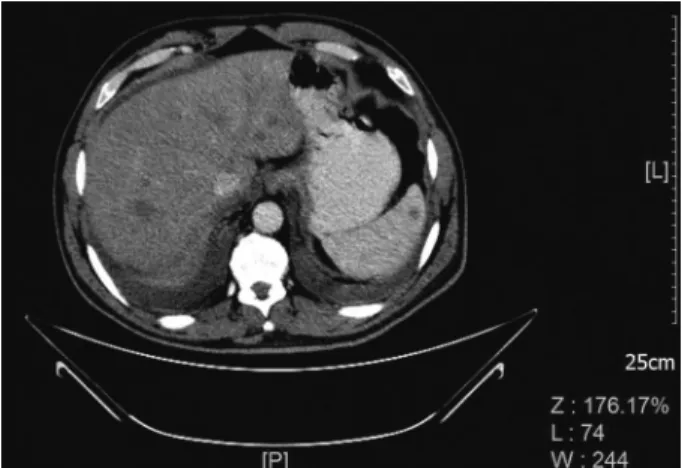 Figure 1.  Multiple  metastasis  and  organomegali  presented in the spleen and liver In the computed  tomography