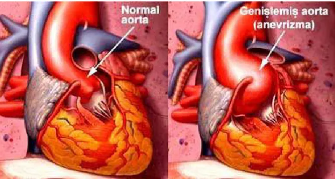 Şekil 4. Solda normal aort , Sağda anevrizmalı aort*