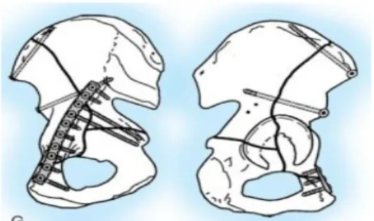 Şekil 34: Bileşik anterior kolon ve posterior hemitransvers kırık 2.8. Temel Cerrahi Yaklaşımlar