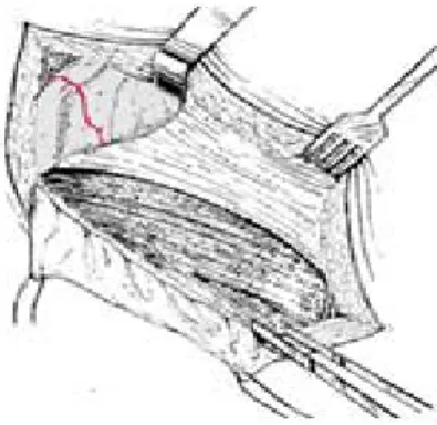 Şekil 36: İnternal iliak fossa ekspoze edildi, eksternal oblik kasın kaldırılmasıyla inguinal kanal ortaya kondu