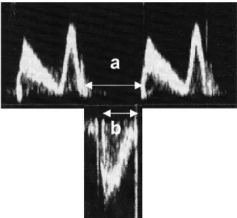 Figure  1.  Pulsed  wave  Doppler  recordings  of  left  ventricular 