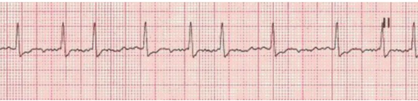 Şekil 1. Atriyal fibrilasyonda EKG.