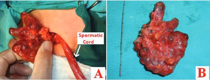 Figure 1. A: The cyst ends separately from the spermatic chord via inguinal incision. B: Multiloculated cyst
