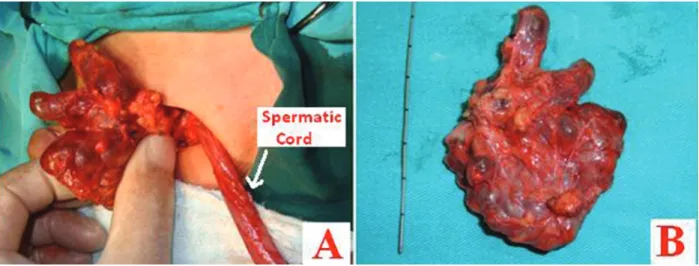 Figure 1. A: The cyst ends separately from the spermatic chord via inguinal incision. B: Multiloculated cyst