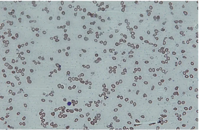 Figure 1. Peripheral  smear showing  macrocytic picture 