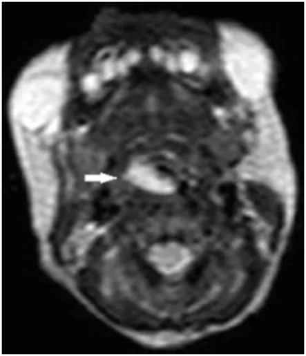 Figure 1. A mass in the larynx partially obstructs the air- air-way on axial MRI (white arrow)