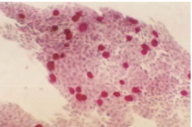 Figure 2.  Grade I differentiation of conjunctival  IC in patients with psoriasis (original  magnification, x 82, PAS and H&amp;E stained)