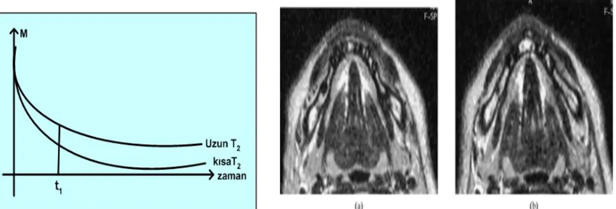Şekil 3. Uzun ve kısa T2 lerin bir arada bulunması durumunda sinyal şiddetleri.  Sağdaki T2-ağırlıklı filmin görüntüsü (Tutton ve Goddard, 2002) 