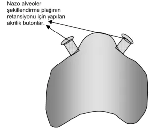 Şekil 2. Çift taraflı dudak damak yarıklı 