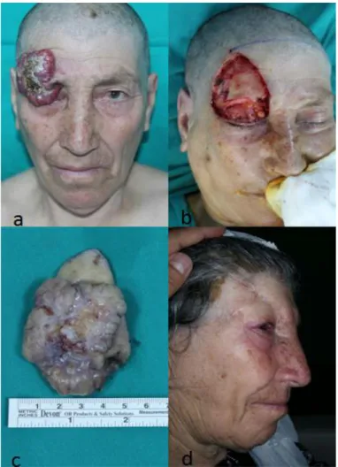 Figure 1. a) A 74-year-old women presented with a large BCC that extended from the right frontal area through the upper and  lateral region of her orbita