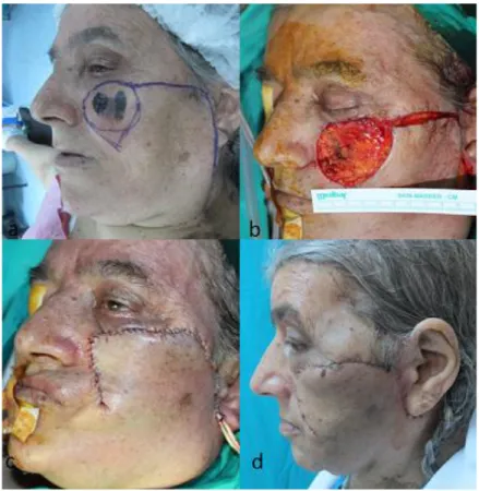 Figure  3.  a)  A  52-year-old  women  with  a  4-year  history  of  malign  melanoma  on  her  left  cheek  applied  for  treatment