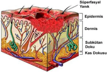 Şekil 2. Süperfasyal kısmi kalınlıktaki yanığın şematik görünümü                 (www.waterjel.nl-img-superficial.gif)