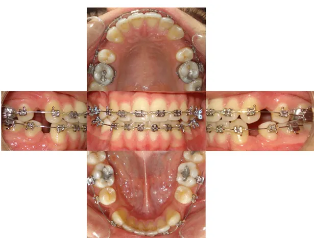 Şekil 2. Aynı hastanın molar mezializasyonuna başlanmadan önceki ağız içi görüntüleri