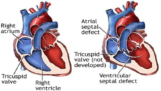 Şekil 2.7. Solda Normal Kalp ve Sağda Triküspit Atrezi’li Kalp (72)