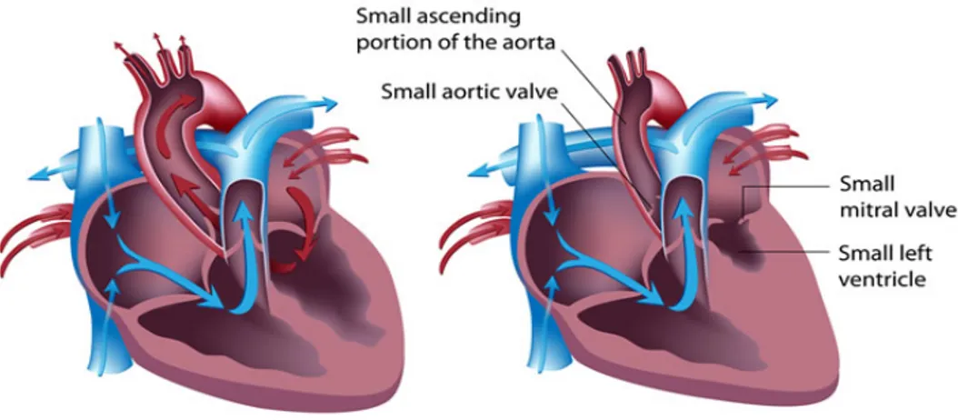 Şekil 2.8. Solda Normal Kalp ve Sağda Hipoplastik Sol Kalp Sendromu (75)