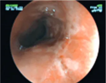 Figure 1. Endoscopic view of the esophageal damage.