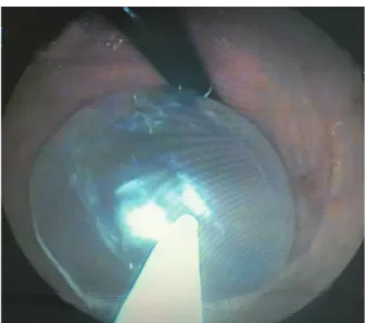 Figure 2. Removal of intragastric balloon