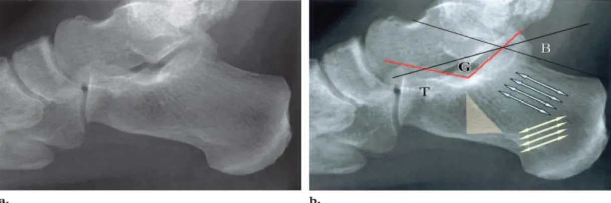 Şekil   2:   a)  Normal   kalkaneus   yan   radyografi  b)  Yan   kalkaneus   grafisinde kompresyon   (mavi   oklar)   ve   traksiyon   (sarı   oklar)   trabekülleri   ve   aradaki   nötral üçgen
