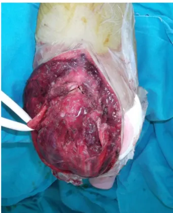 Şekil 13 : olekranon osteotomi kesisi  