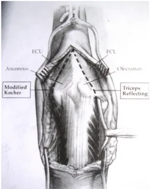 Şekil  15.  Lateral  modifiye  kocher,  medial  triceps  reflekting  açılımlarından  oluşan  trap 