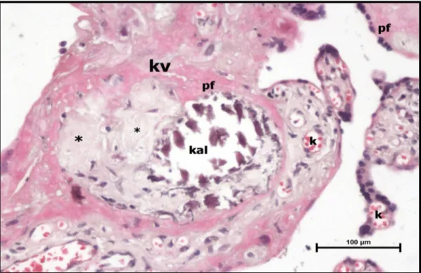 Şekil 20: Preeklampsi grubu santral plasenta kesiti, konjesyon ve dilate terminal villus kapillerleri (k), ile perivillöz fibrin (pf) birikimi, kalsifikasyon odakları(kal) ve infarkt alanları (*) izlenmektedir (H-E, Bar: 100μm).